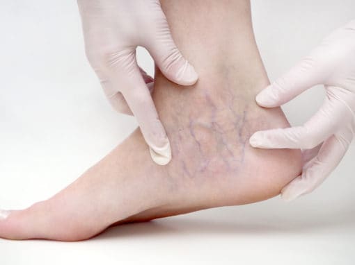 Sclerotherapy injection for spider and varicose veins