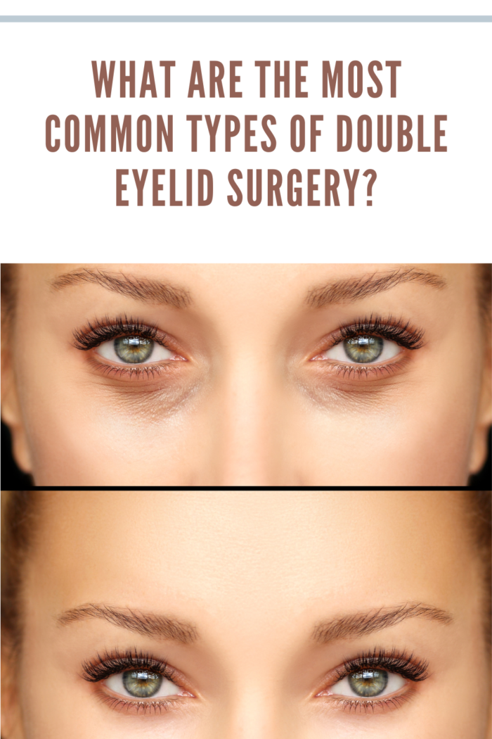 before and after Blepharoplasty of the lower eyelid.