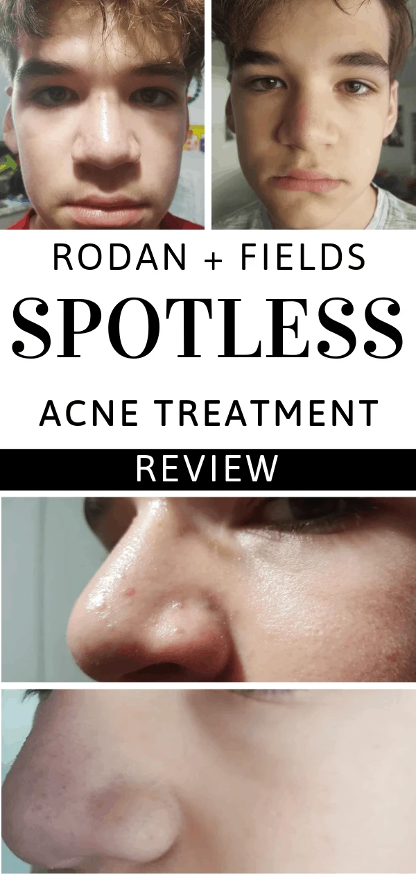 This Rodan + Fields SPOTLESS acne treatment review shows before and after photos. The improvement of two weeks is amazing.