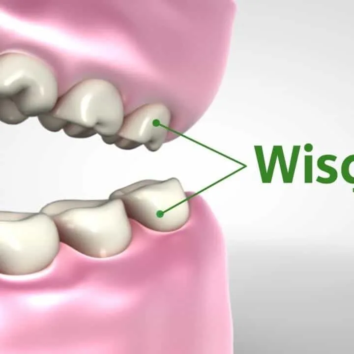 Wisdom teeth, also known as third molars, usually appear mid-teenage and mid-twenties. Here are the reasons you should have your wisdom teeth removed.
