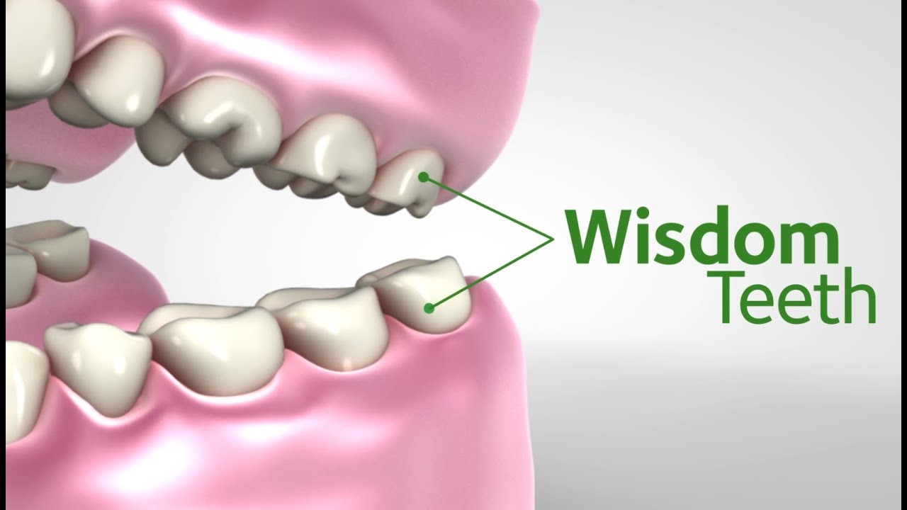 Why Wisdom Teeth Should Be Removed • Mommy's Memorandum