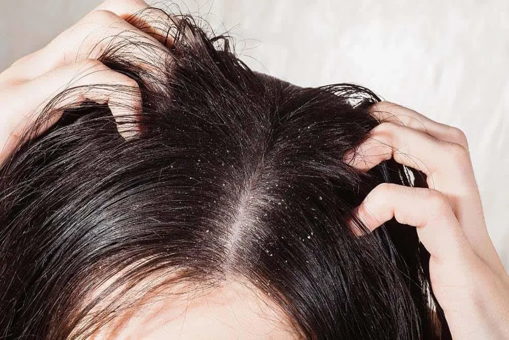 the quick way to say goodbye forever to dandruff is to use Dead Sea salt.
