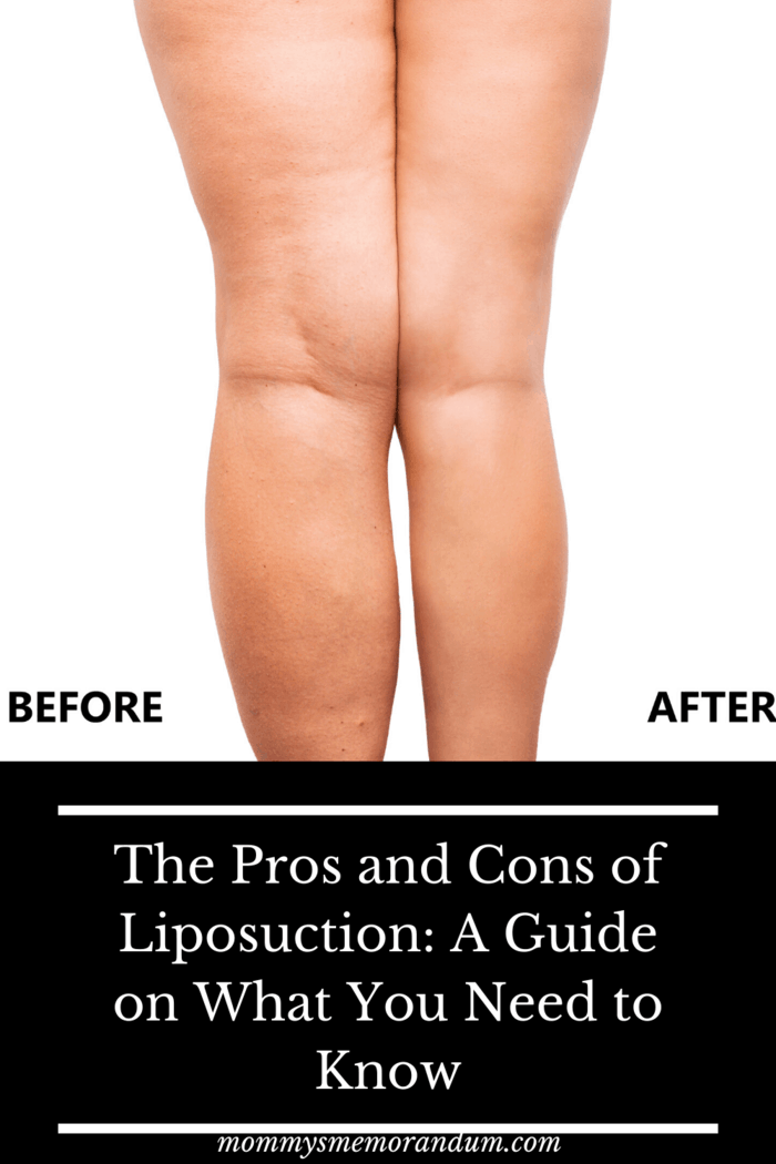 before and after of liposuction surgery on legs