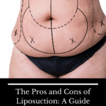 stomach marked for liposuction surgery
