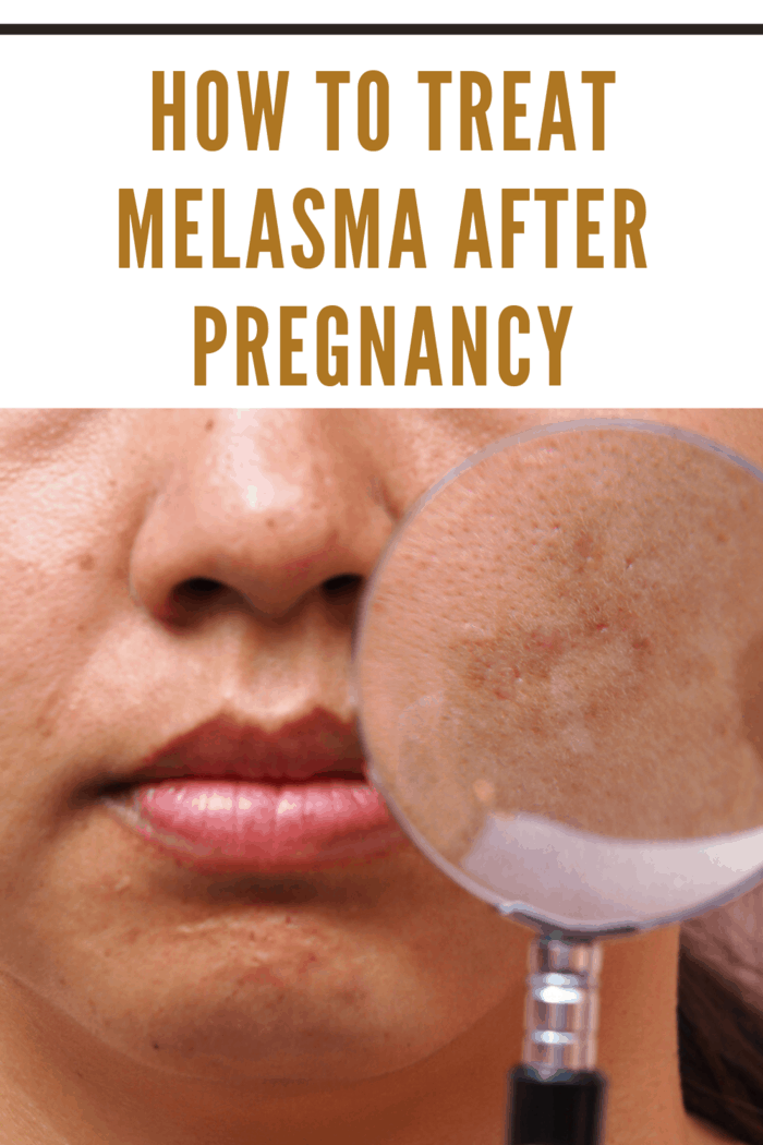 woman with melasma on face holding magnifying glass over it