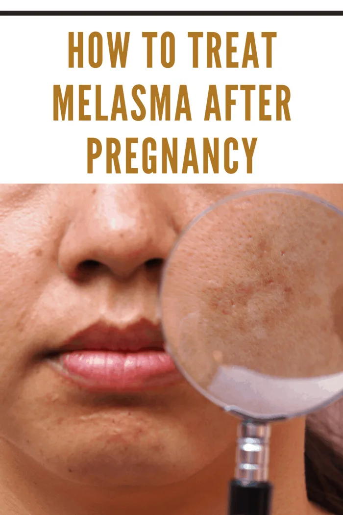 woman with melasma on face holding magnifying glass over it