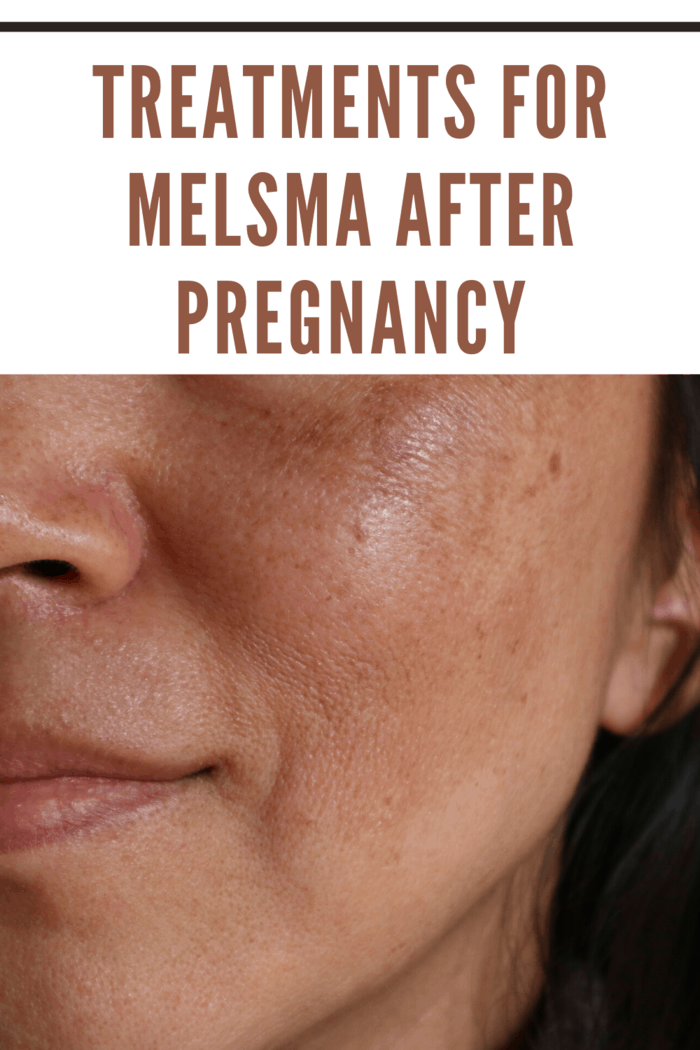 You can protect your skin during the day while lightening the Melasma spots.