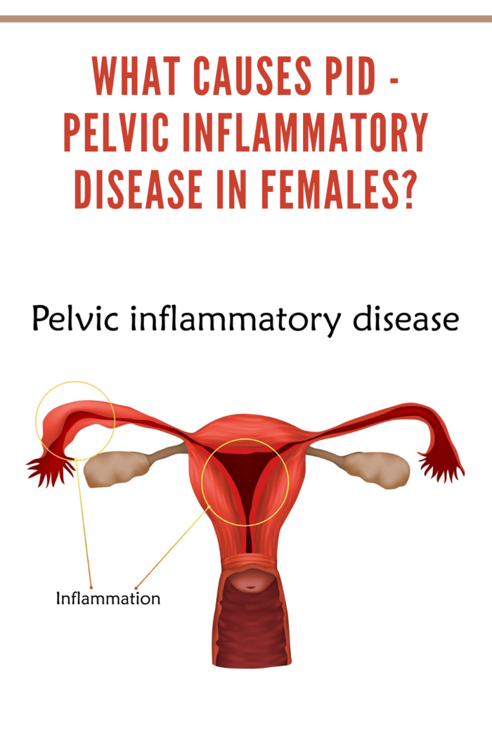 What Causes PID - Pelvic Inflammatory Disease in Females