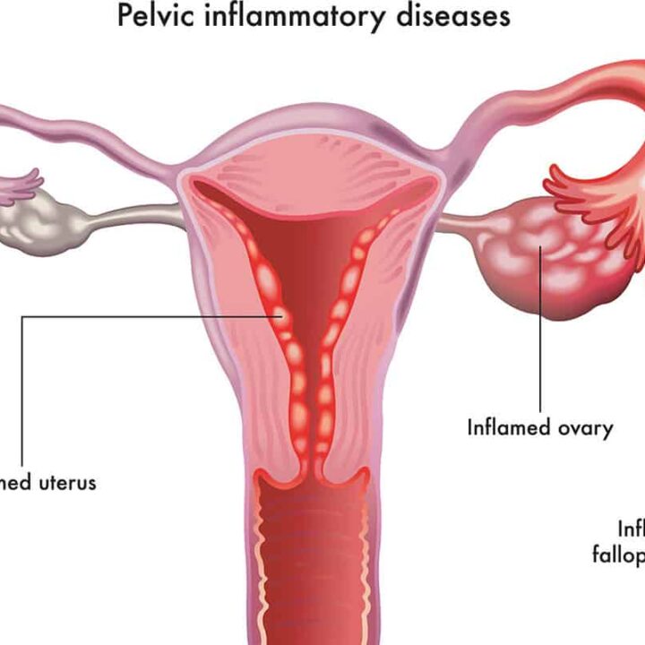 What Causes PID – Pelvic Inflammatory Disease in Females?