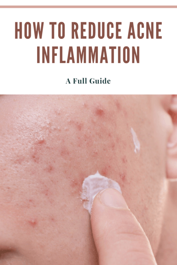 Applying acne medication to inflamed acne on face for reducing redness and swelling