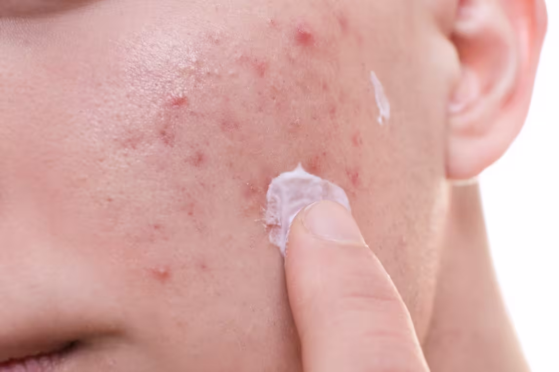 How to Reduce Acne Inflammation: Gentle Tips for Calmer, Healthier-Looking Skin
