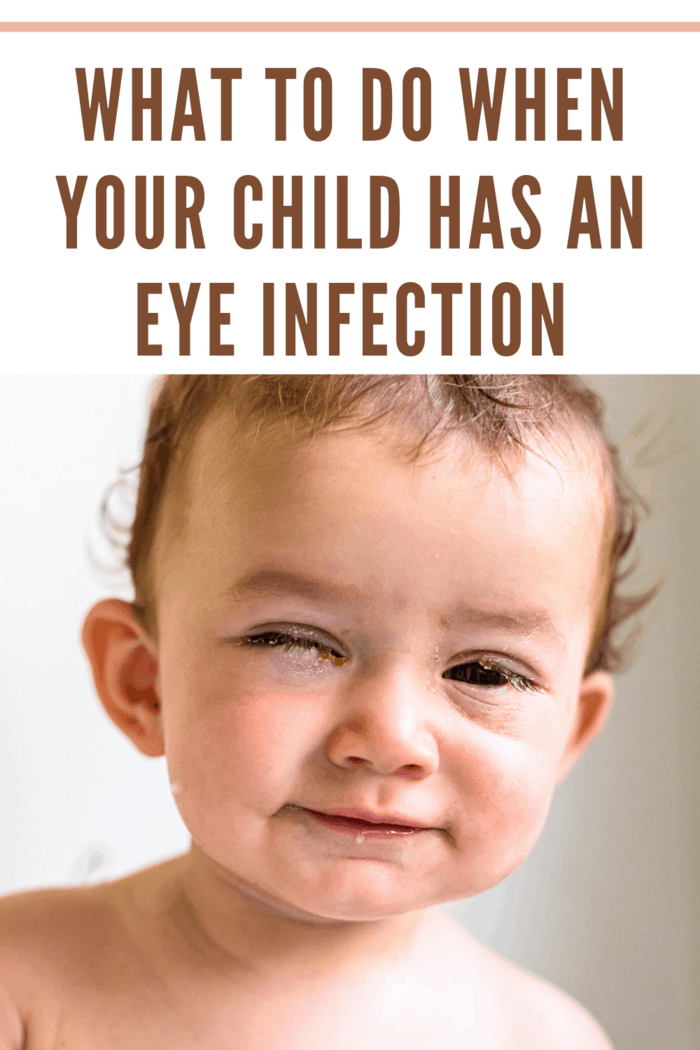 baby with eye infection