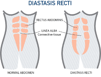 Diastasis Recti diagram