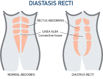 Diastasis Recti diagram