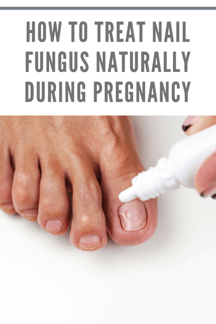 Fungus of the nail plate (onychomycosis). Nail Care, Nail Fungus Treatment, A healthy foot, beautician applies a care product concept of treating nail fungus during pregnancy