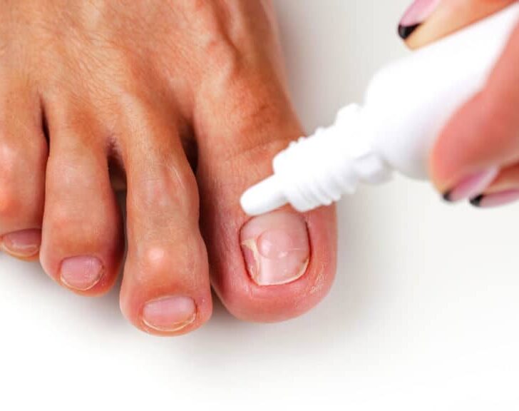 Close-up of tea tree oil bottle and dropper, a natural remedy for treating nail fungus safely during pregnancy