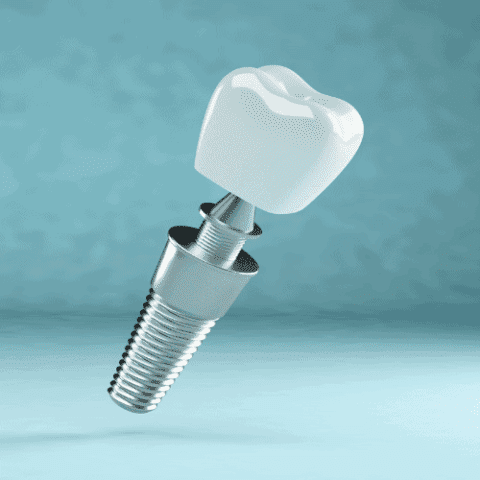 An Overview of the Procedure and Types of Dental Implants